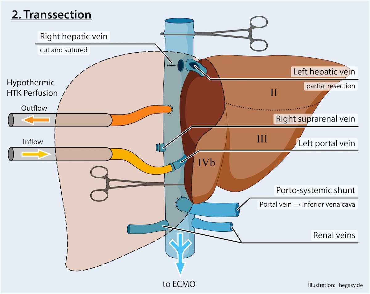 Illustration der Leber-Teilresektion und den verschiedenen Perfusionskreisläufen.